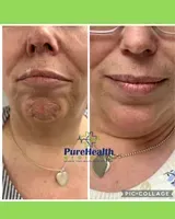 Before-and-after close-up of a chin and neck with visible skin improvement, split into two panels.