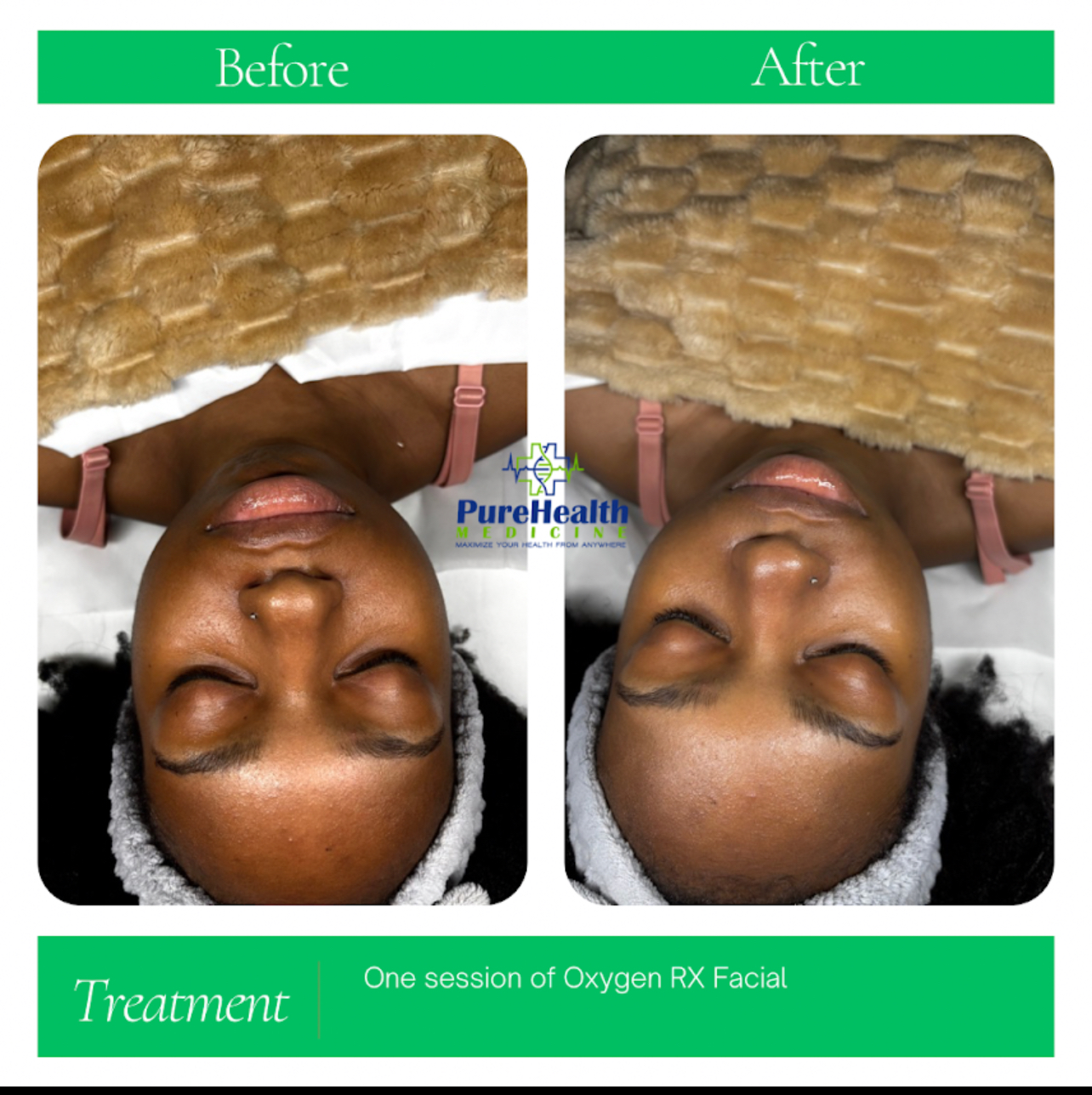 Oxygen RX Facial Before and After
