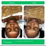 Before-and-after facial image showing treatment results, with a woman’s face centered and labeled “Before” and “After.”