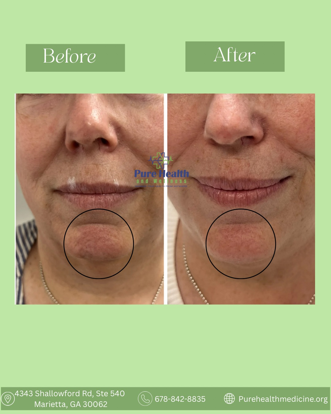 Before-and-after close-up of lower face showing reduced chin wrinkles and smoother skin.