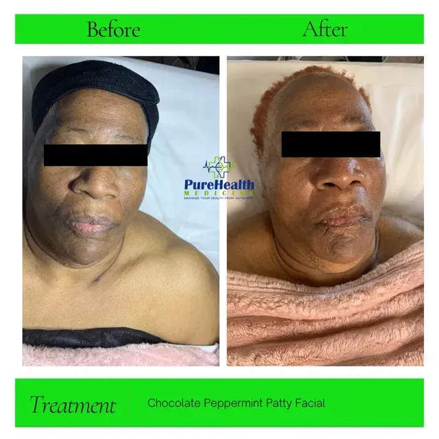 Before-and-after facial treatment comparison with two side-by-side portraits and “Chocolate Peppermint Patty Facial” text.