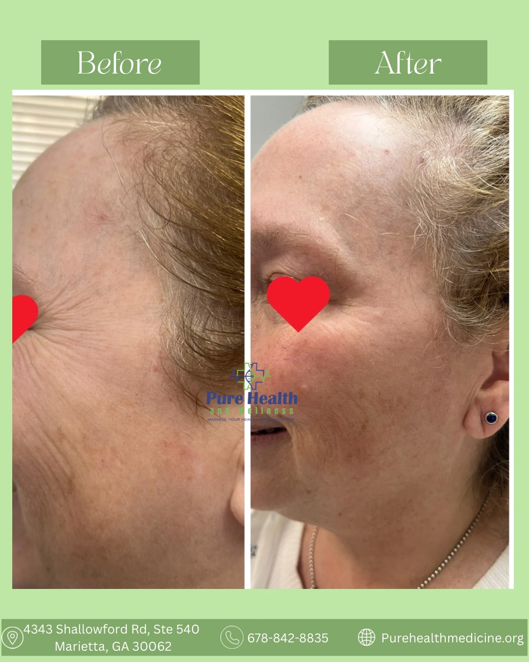 Side-by-side before-and-after profile photos showing a facial skin treatment result.