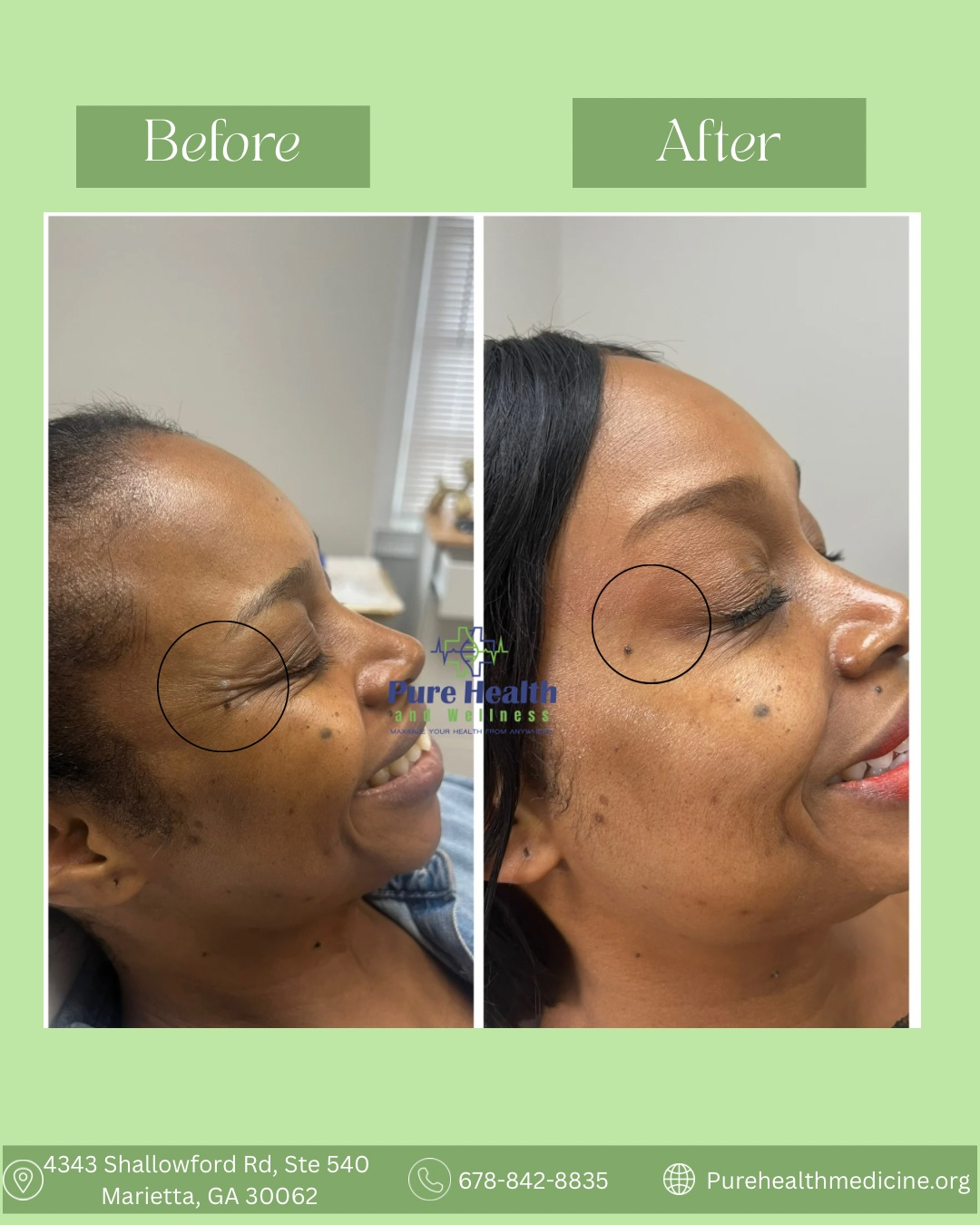 Side-by-side facial profile photos labeled Before and After, with circled eye area on a green background.