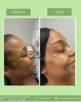 Before-and-after side-by-side facial profile photos with a circle highlighting the cheek area.