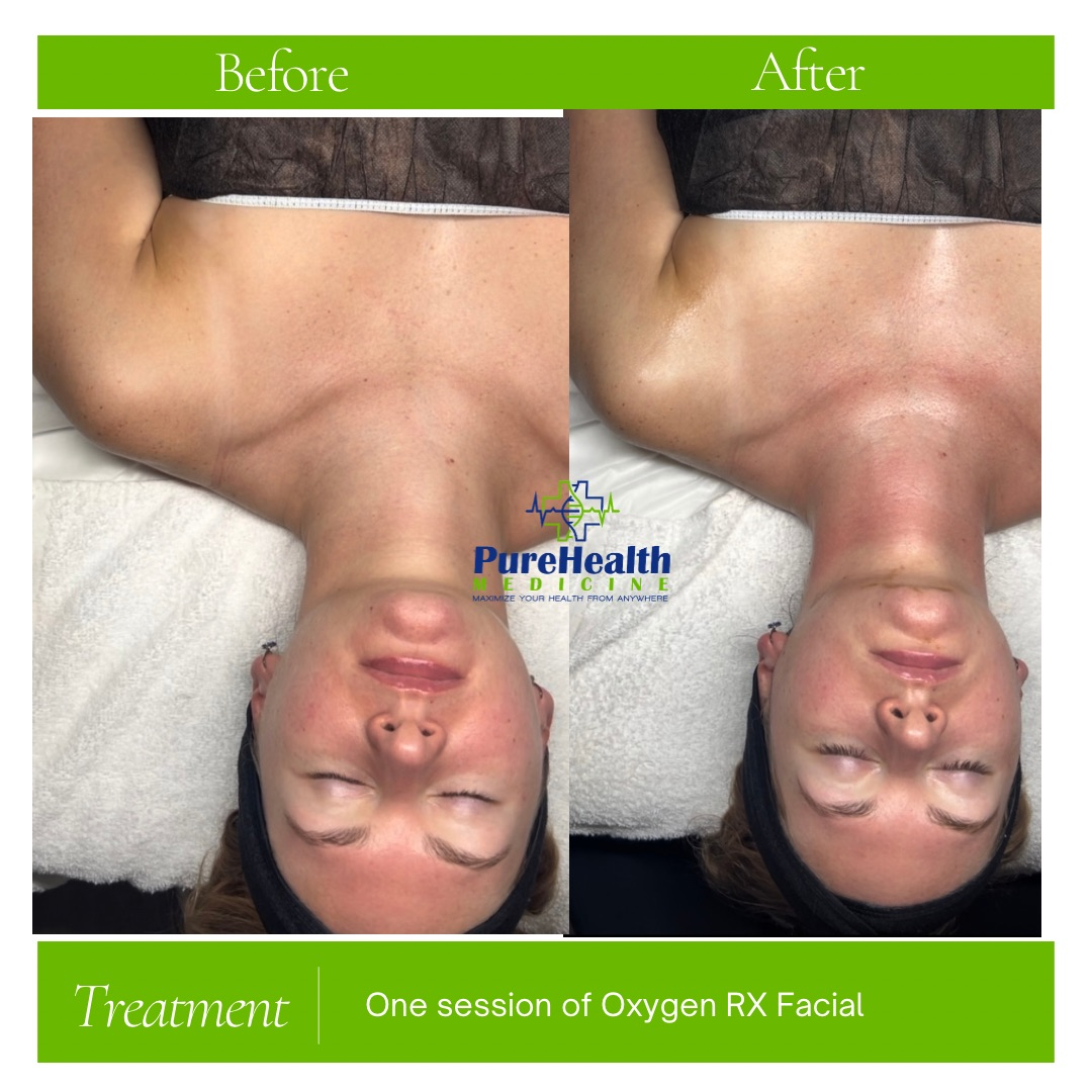 Oxygen RX Facial Before and After

