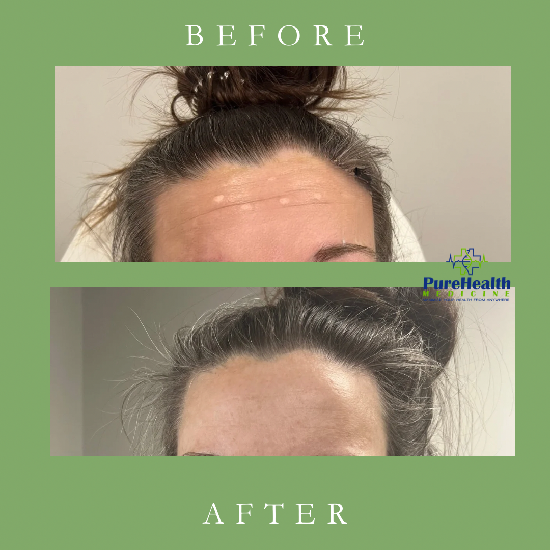 Before-and-after close-up of a forehead treatment, showing reduced wrinkles with a clinic logo and labels.