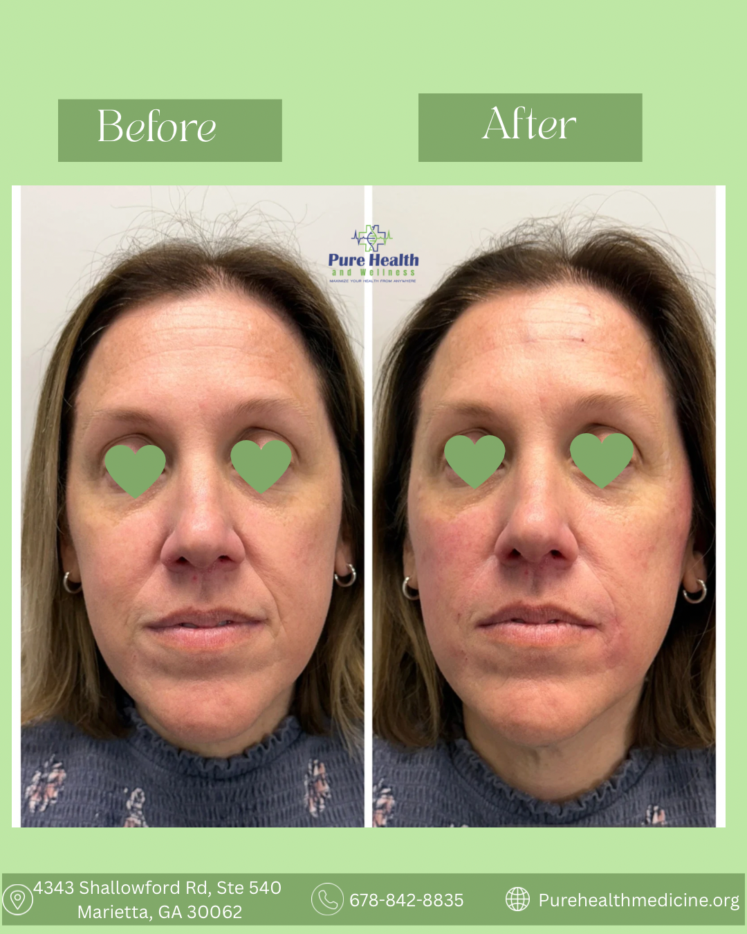Before-and-after cosmetic face comparison: green eye masks, smoother skin, and subtle lip shape changes.