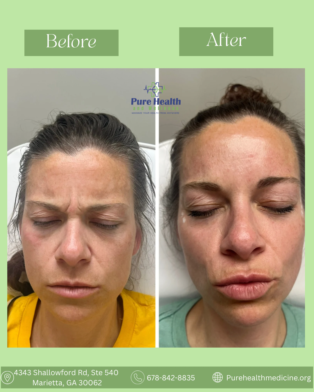 Before-and-after facial photos showing closed eyes and a wrinkled nose, likely a cosmetic treatment result.