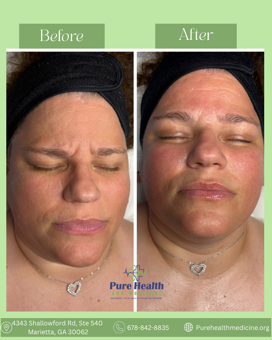 Side-by-side before-and-after face photos showing reduced swelling and redness after treatment.