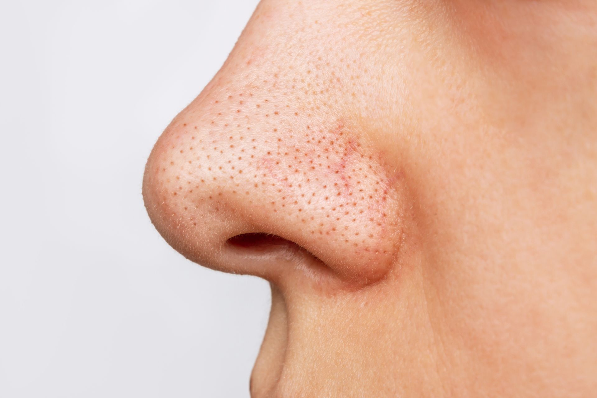Close-up of a human nose with visible pores and blackheads on light skin