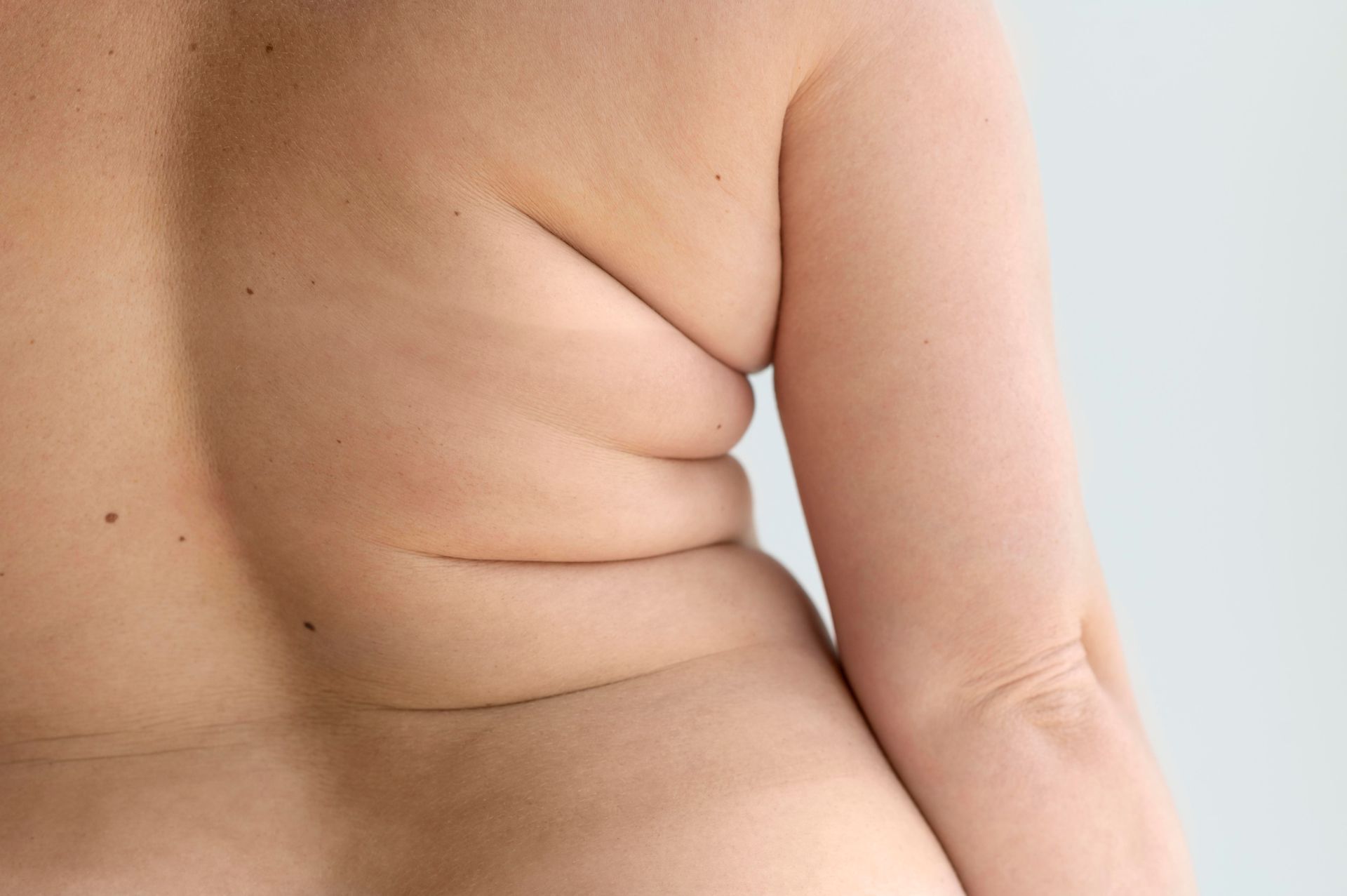 Close-up of a person’s side torso with visible skin folds and arm against a plain background