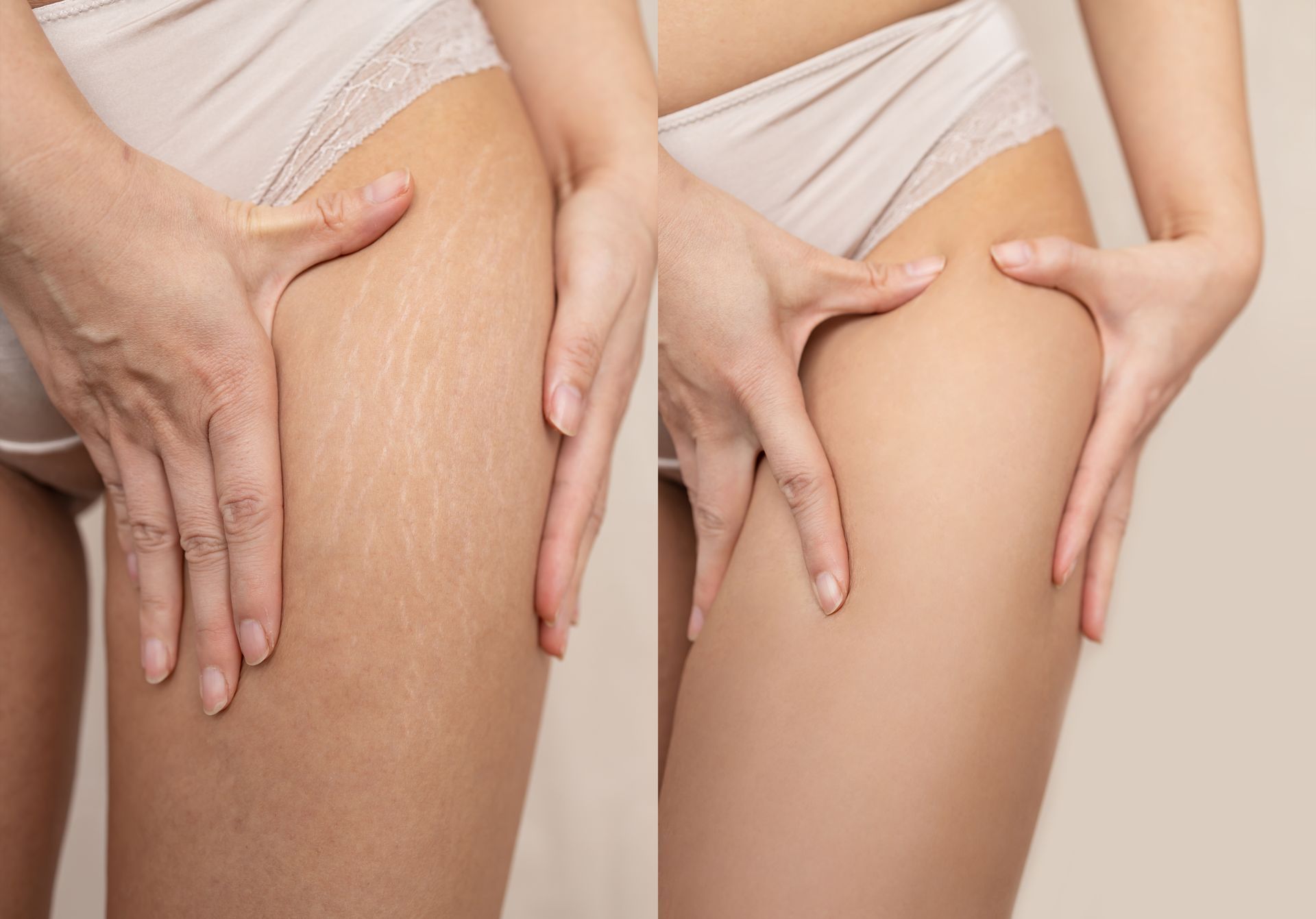 Before and after of a women in white underwear demonstrating thigh skin texture by pinching and holding their legs