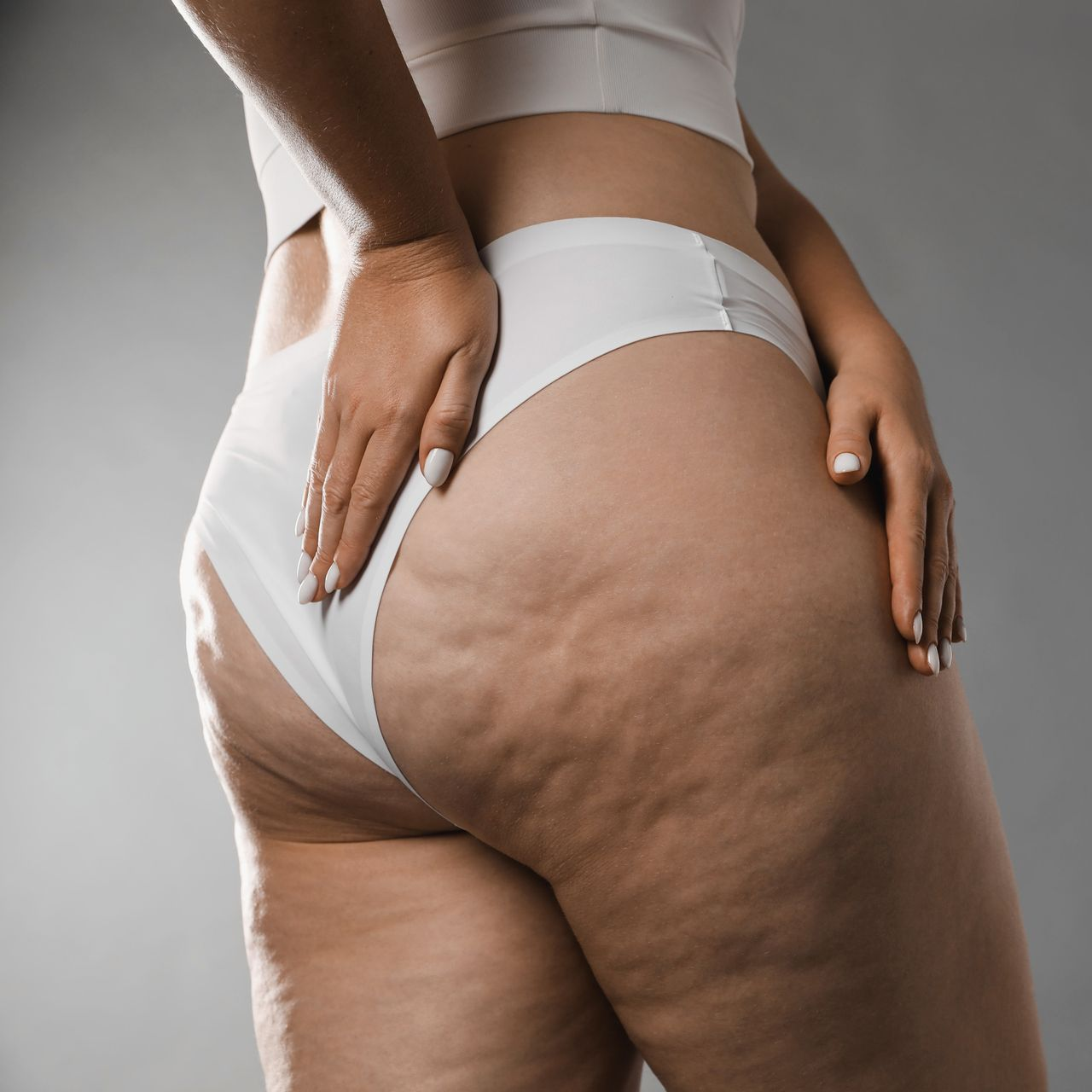 Close-up of a person wearing white underwear, showing skin with visible stretch marks against a gray background