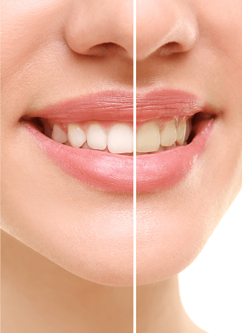 Teeth Whitening - Park Place Dental