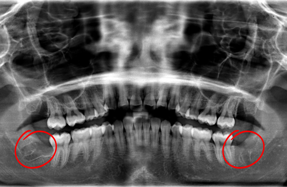 Dental panoramic X-ray showing teeth and jaw with wisdom teeth highlighted in red circles.