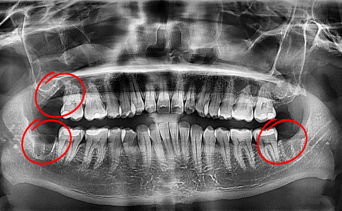 Dental panoramic X-ray showing teeth and jaw with wisdom teeth highlighted in red circles.