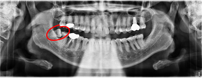 Panoramic dental X-ray shows teeth, with circled wisdom teeth impacted on both sides of the lower jaw.