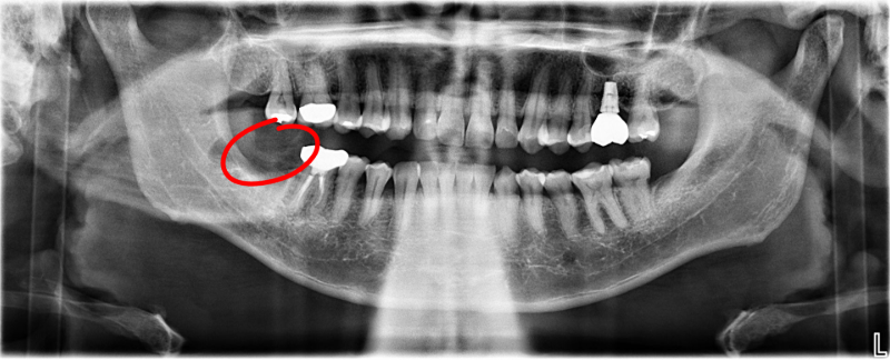 Dental panoramic X-ray showing teeth and jaw with wisdom teeth highlighted in red circles.