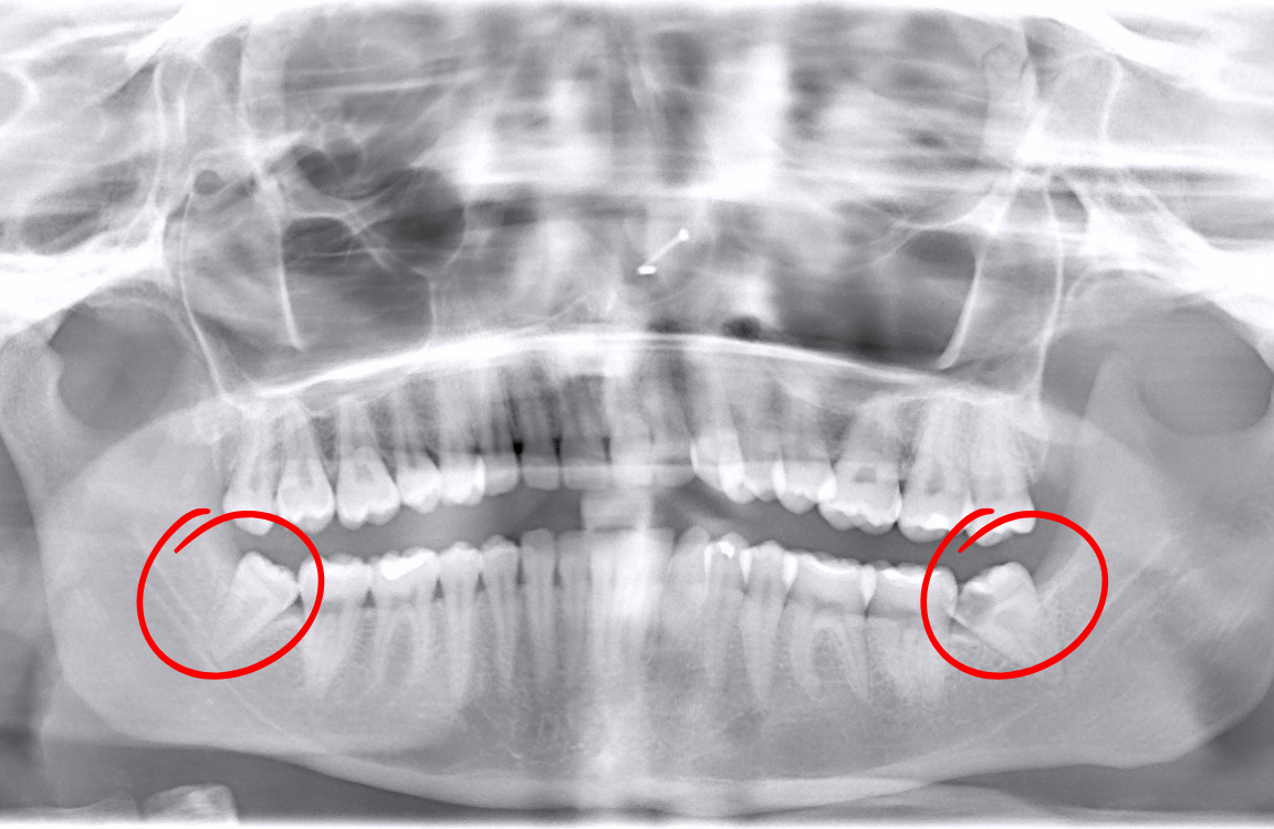 Dental panoramic X-ray with wisdom teeth highlighted by red circles.