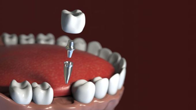 A close up of a tooth with a crown on top of it.
