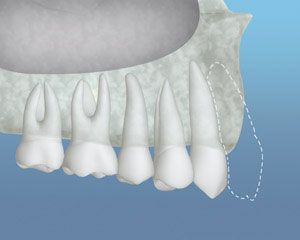 A close up of a person 's teeth on a blue background.