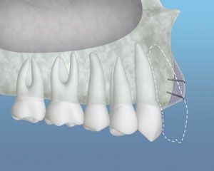 A close up of a person 's teeth with a blue background.