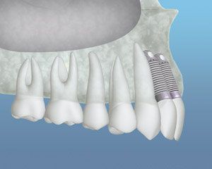 A close up of a tooth with a dental implant in it.