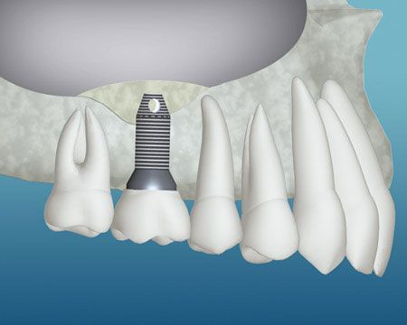 A computer generated image of a dental implant in the lower jaw.