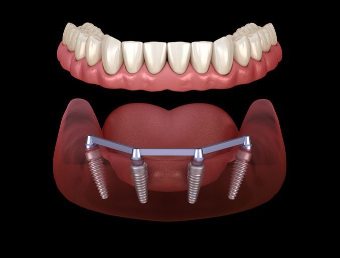 A 3D medical illustration showing a dental implant bar supported by four implants below a removable full denture.