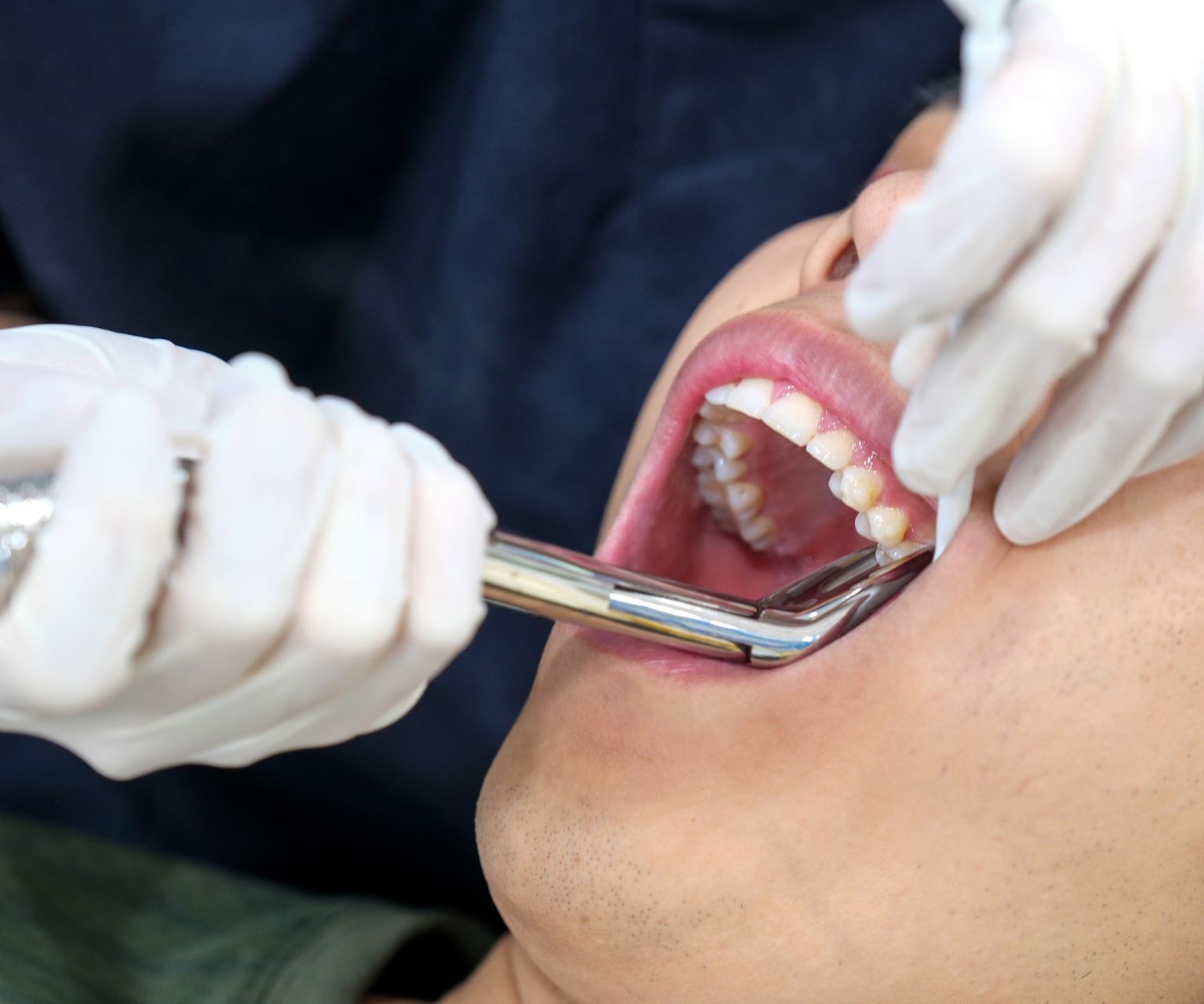 A man is getting his teeth examined by a dentist