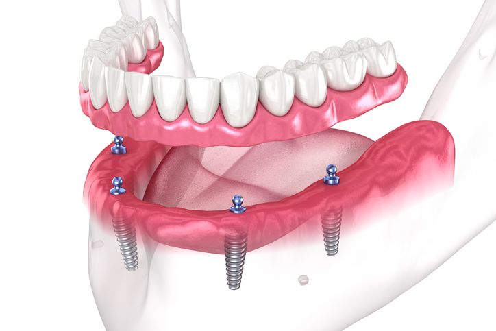 Dental illustration of a lower denture being attached to four dental implants anchored in the jawbone.