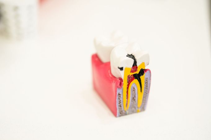 A model of a tooth with a hole in it on a table.
