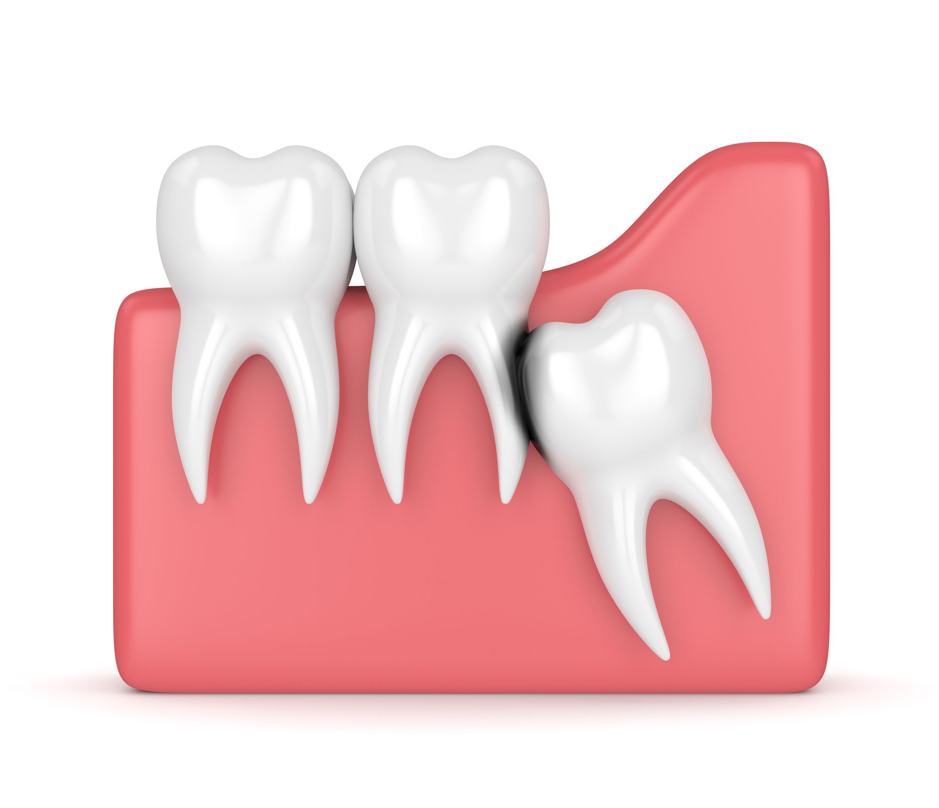 Illustration of three teeth in pink gums, one impacted wisdom tooth.