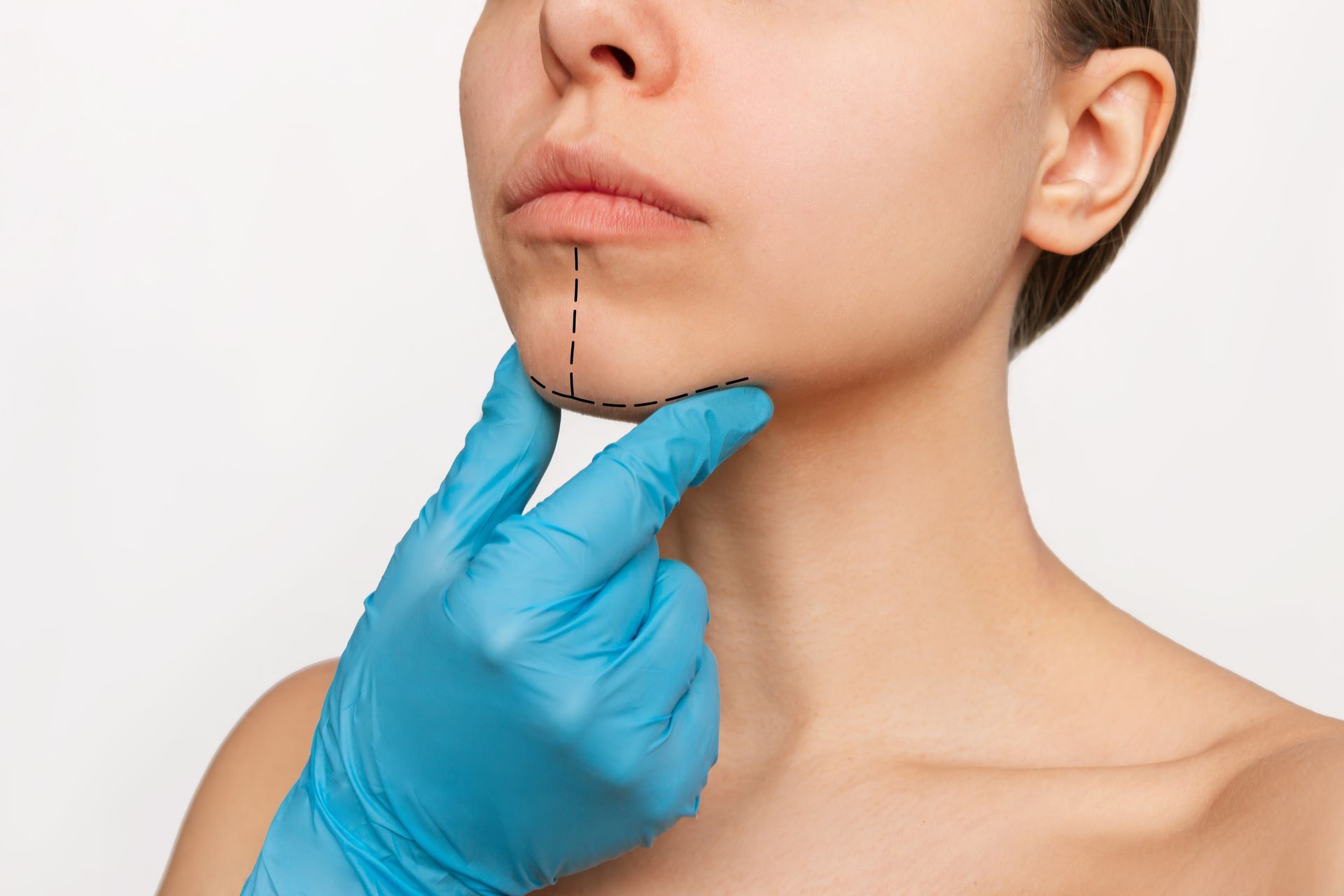 Woman with chin marked for cosmetic procedure; gloved hand indicates the planned area.