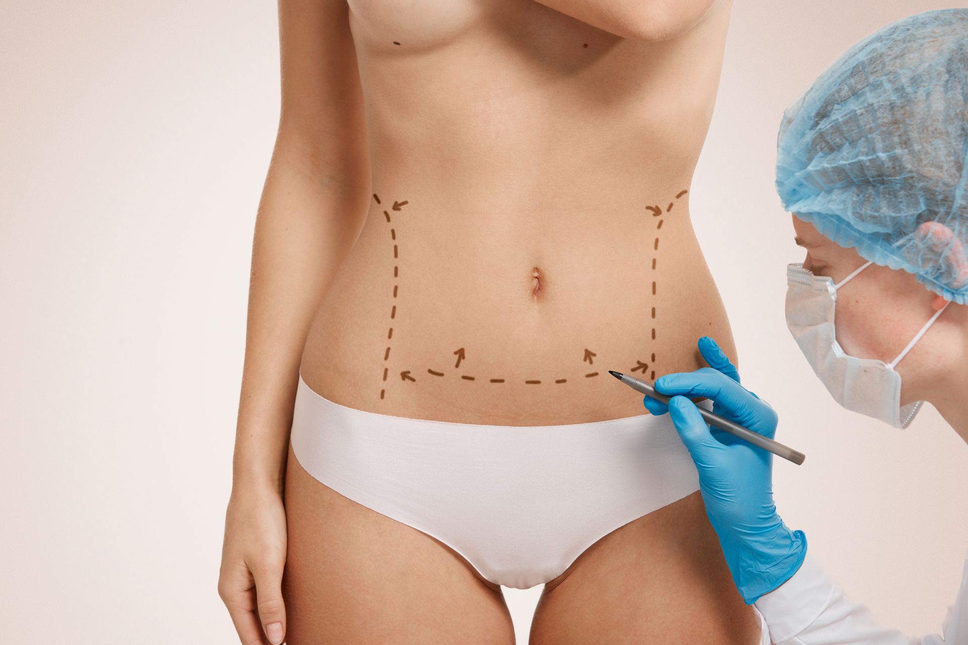 A doctor marks a woman's abdomen with a pen, outlining a possible tummy tuck procedure.