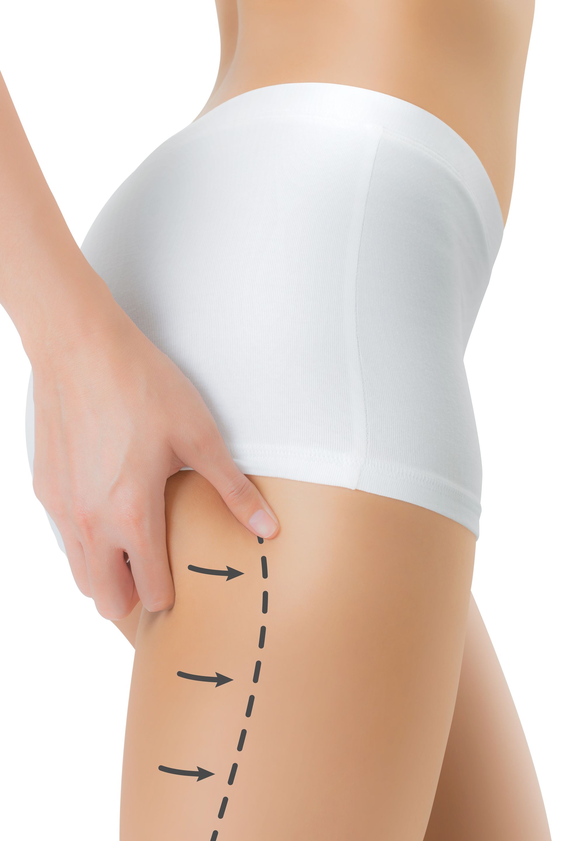 A woman in white underwear pinching thigh skin, with dotted line and arrows indicating a procedure.