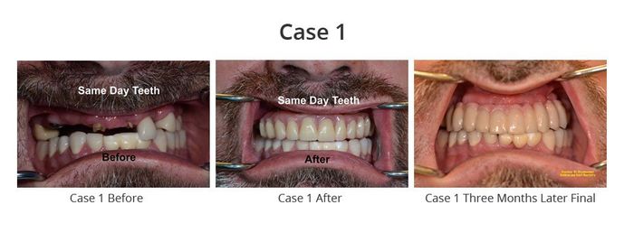 Before and After Teeth Whitening — Fort Myers, FL — Children & Adult Dentistry Before and After Teeth Whitening — Fort Myers, FL — Children & Adult Dentistry