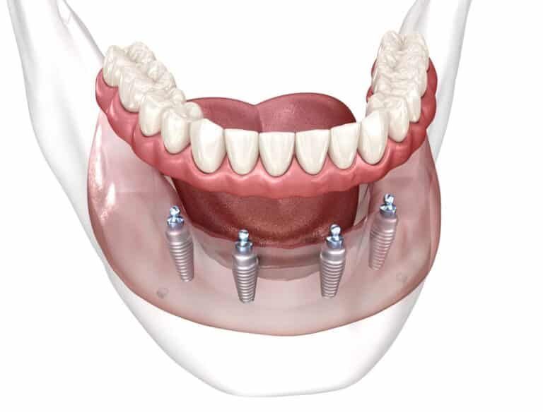 Oral surgeon consulting with a young orthodontic patient