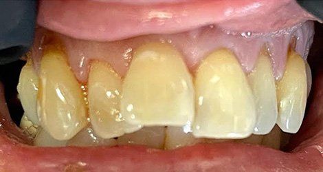 Before and after Implant