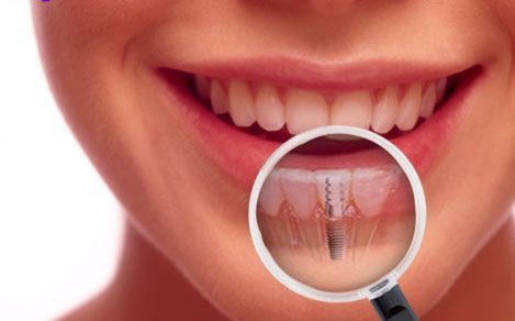 A woman is smiling with her implant showing through a magnifying glass