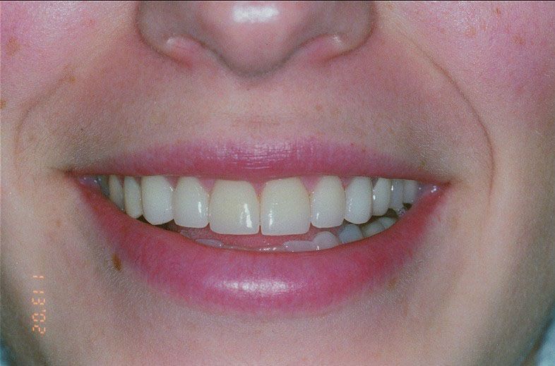 A close up of a woman 's smile with white teeth.