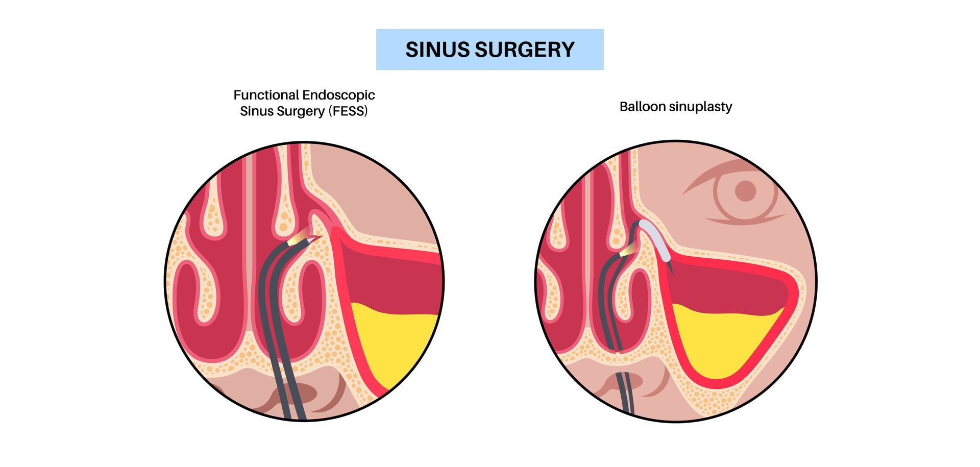Side-by-side ear diagrams showing sinus surgery: before and after drainage of blocked sinus.