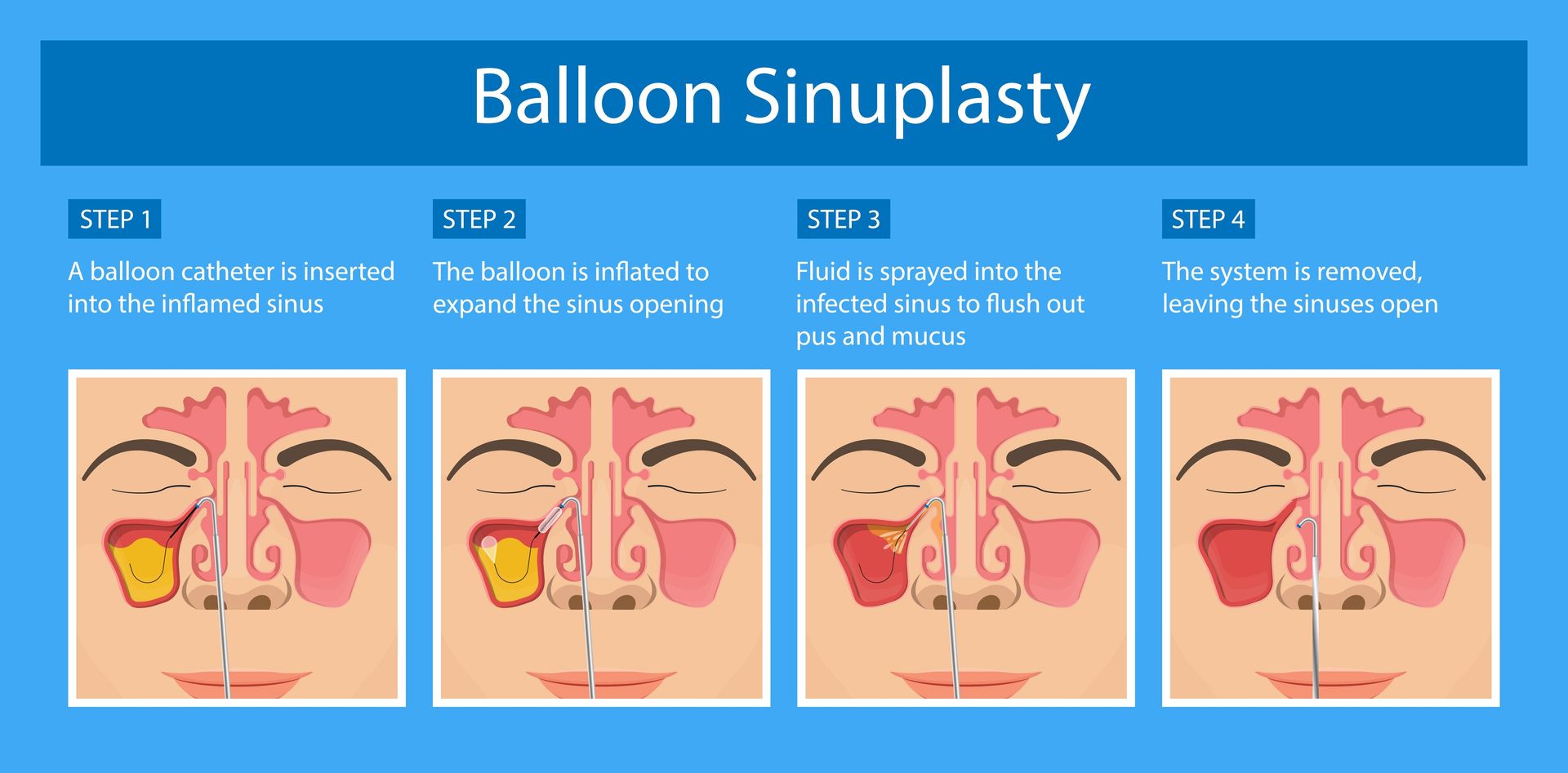 Balloon sinuplasty infographic with four step-by-step medical diagrams on a blue background