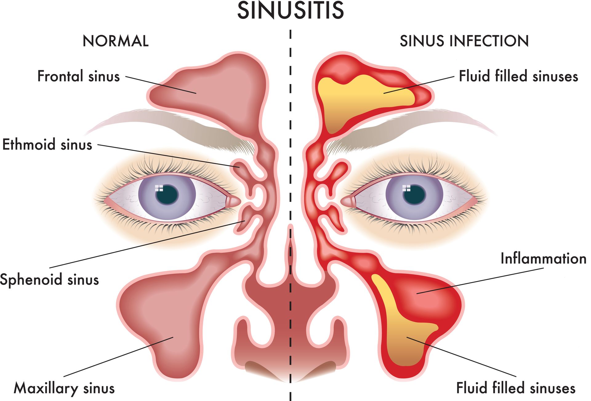 Sinusitis diagram comparing normal sinuses with inflamed, fluid-filled sinus infection
