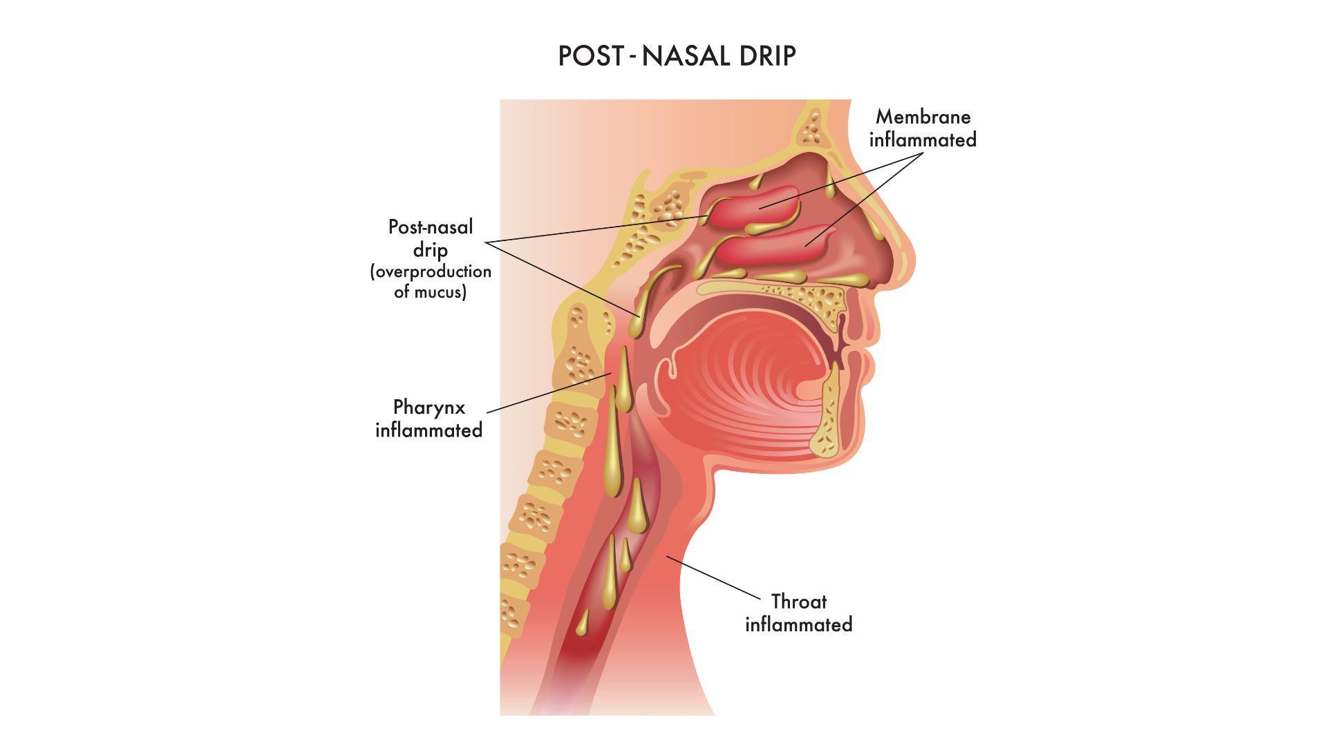 Diagram of the upper airway showing post-nasal drip and labeled nasal passages and throat.