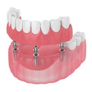 A Dental Arch With Teeth Being Placed Onto Four Metal Implants — Killara Dental in East Killara, NSW