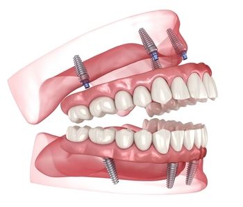A Digital Medical Model Showing Full Arch Dental Implants — Killara Dental in East Killara, NSW