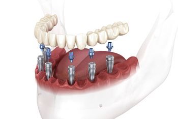 A Dental Implant Bridge Showing Six Metal Implants in the Jaw — Killara Dental in East Killara, NSW