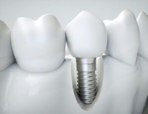 3d Illustration Showing a Dental Implant With a White Porcelain Crown — Killara Dental in East Killara, NSW