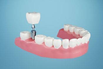 A Dental Model of a Lower Jaw Showing a Tooth Implant With a Separate Crown — Killara Dental in East Killara, NSW